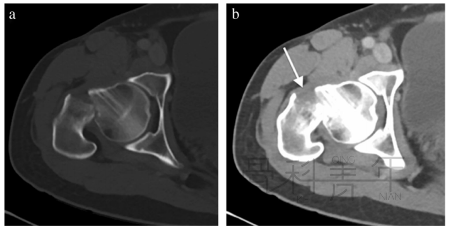 关节积脂血症(lipohemarthrosis)-8