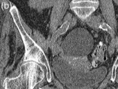 关节积脂血症(lipohemarthrosis)