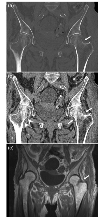 关节积脂血症(lipohemarthrosis)-10