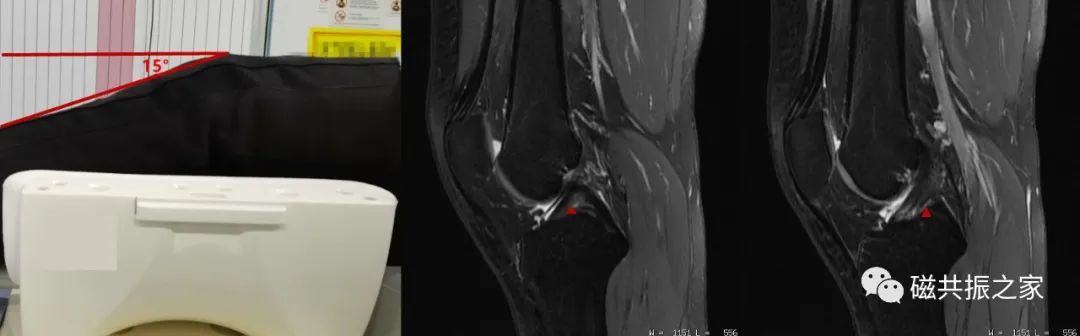 膝关节MRI扫描中的一系列问题-3