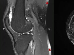 膝关节MRI扫描中的一系列问题