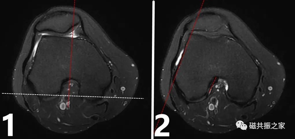 膝关节MRI扫描中的一系列问题-6