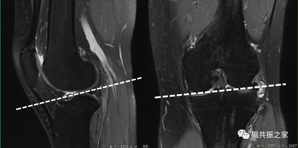 膝关节MRI扫描中的一系列问题-7