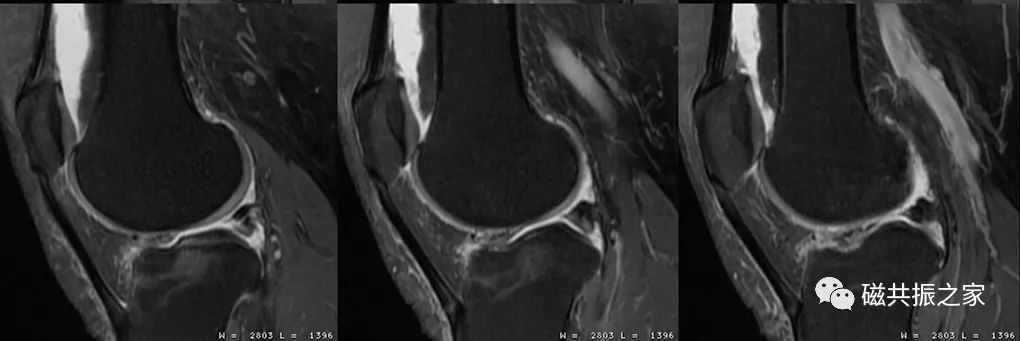 膝关节MRI扫描中的一系列问题-8