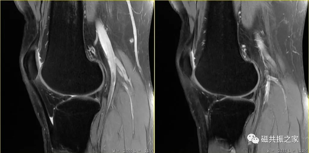 膝关节MRI扫描中的一系列问题-9