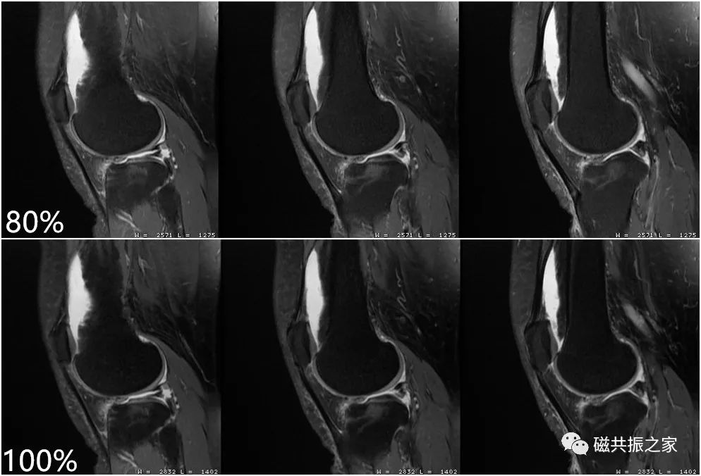 膝关节MRI扫描中的一系列问题-11