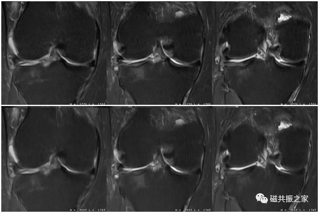 膝关节MRI扫描中的一系列问题-12
