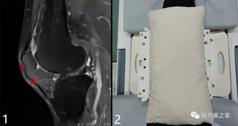 膝关节MRI扫描中的一系列问题-13