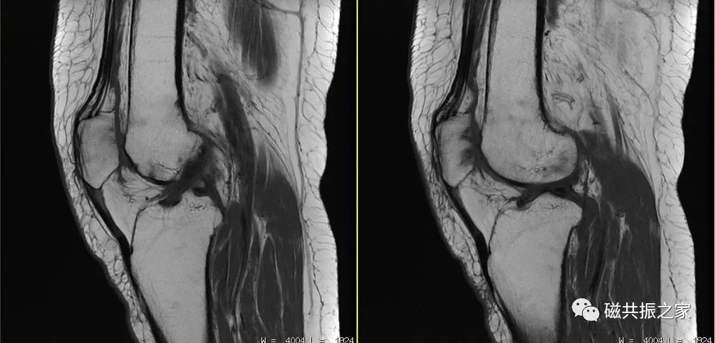 膝关节MRI扫描中的一系列问题-14