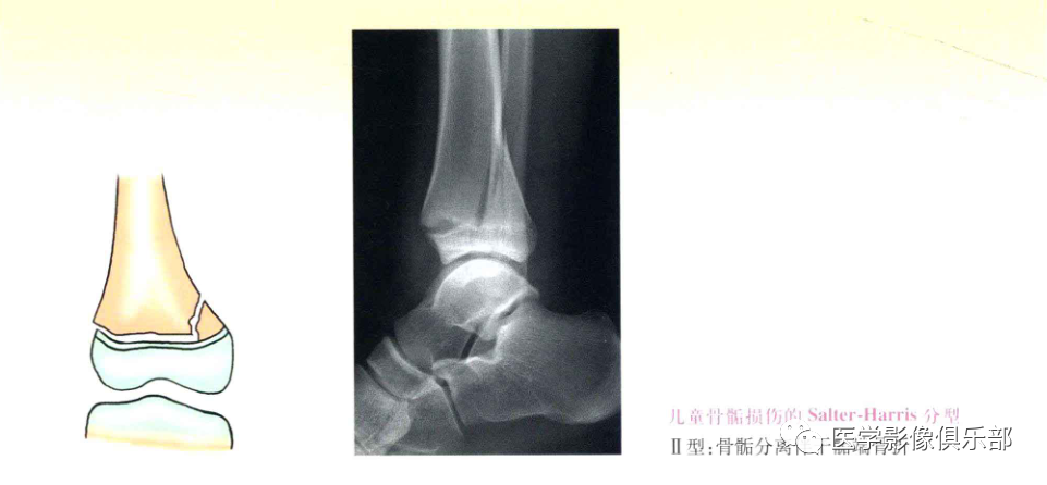 儿童骨骺损伤/骨折分型-3