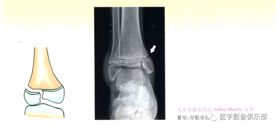 儿童骨骺损伤/骨折分型-4