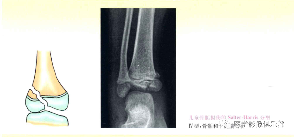 儿童骨骺损伤/骨折分型-5