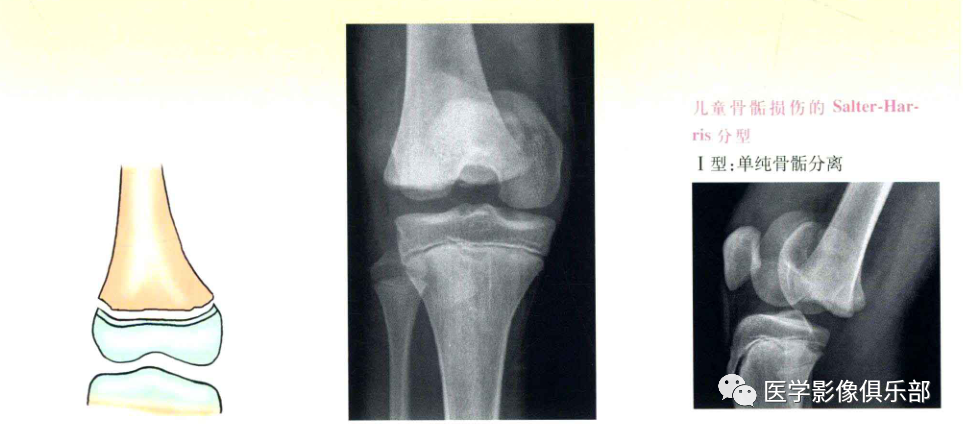 儿童骨骺损伤/骨折分型-2