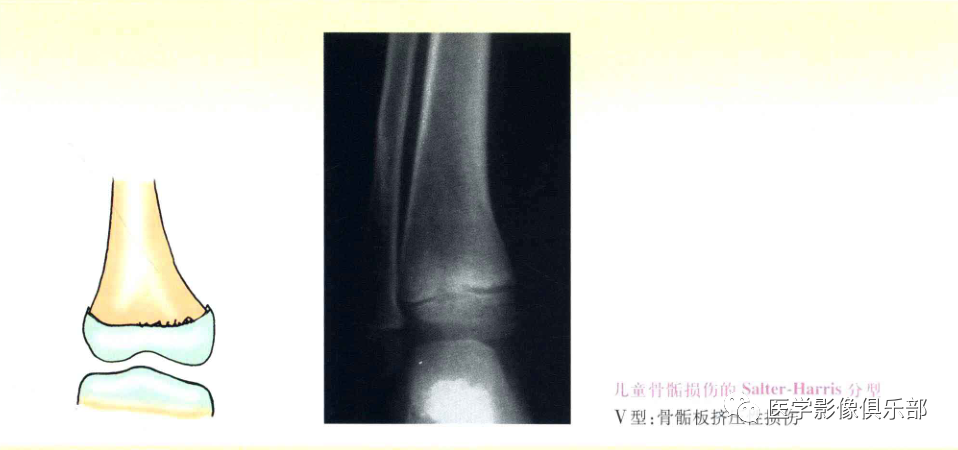 儿童骨骺损伤/骨折分型-6