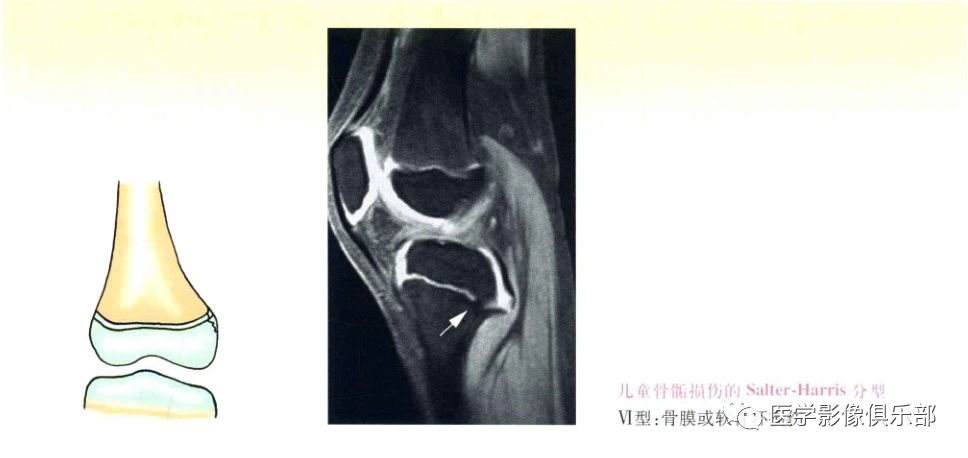 儿童骨骺损伤/骨折分型-7