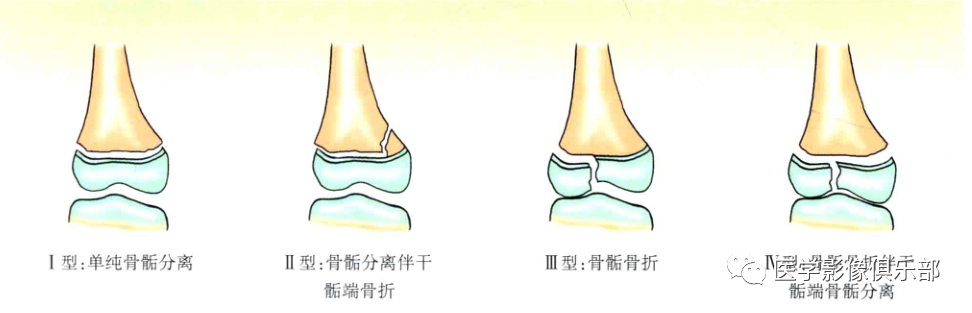 儿童骨骺损伤/骨折分型-9