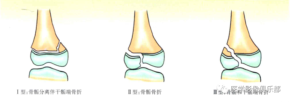 儿童骨骺损伤/骨折分型-11