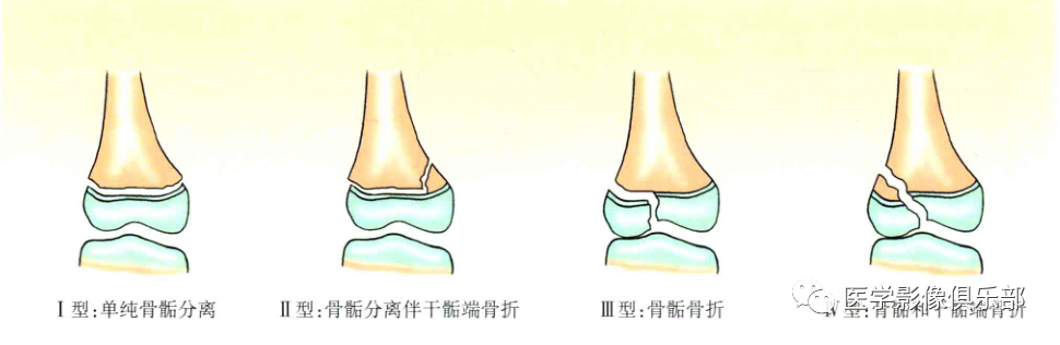 儿童骨骺损伤/骨折分型-12