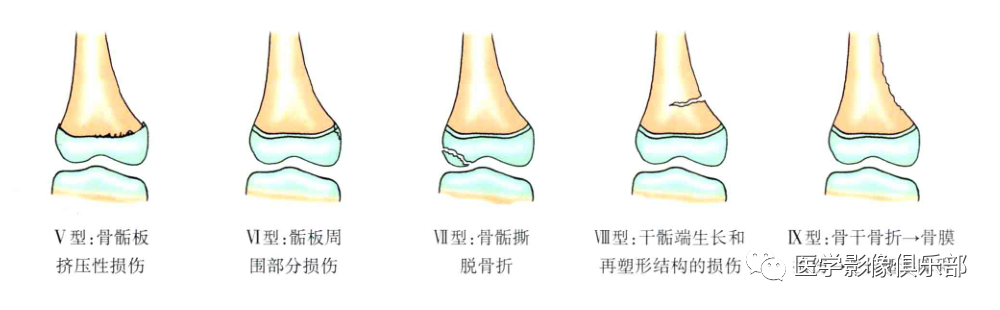 儿童骨骺损伤/骨折分型-13