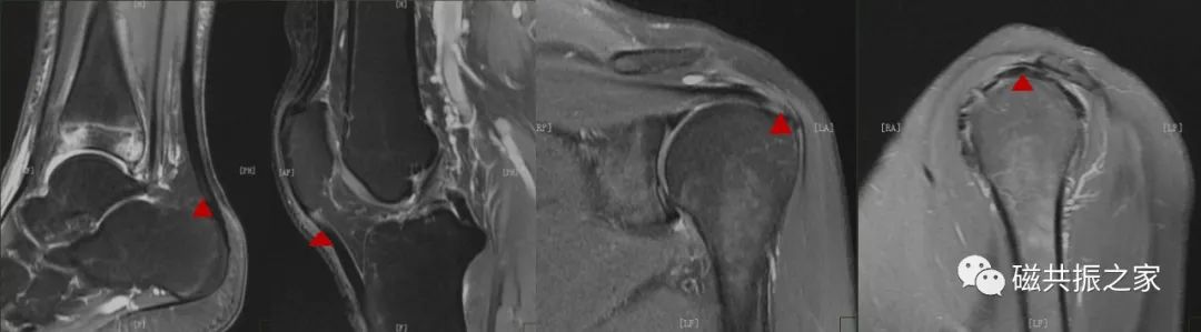 临床扫描中遇到魔角效应该怎么办？-1