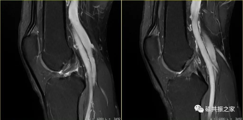 临床扫描中遇到魔角效应该怎么办？-7