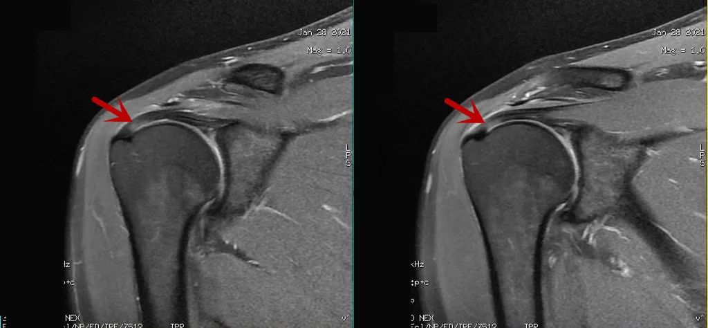 临床扫描中遇到魔角效应该怎么办？-6