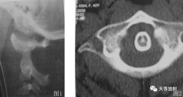 环枢椎关节半脱位-2