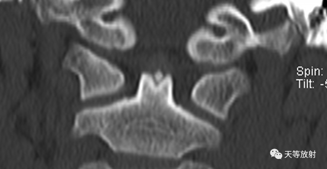 环枢椎关节半脱位-4