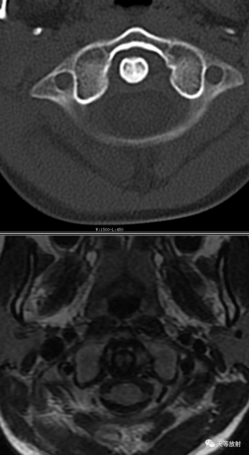 环枢椎关节半脱位-1