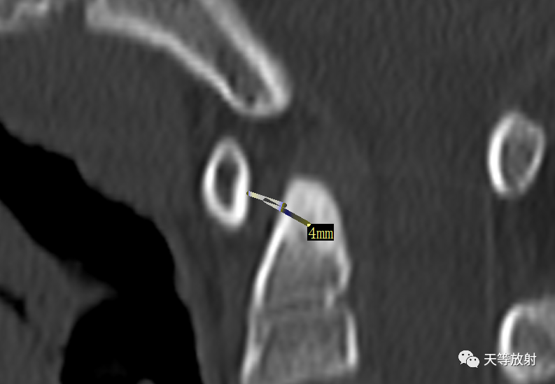 环枢椎关节半脱位-3
