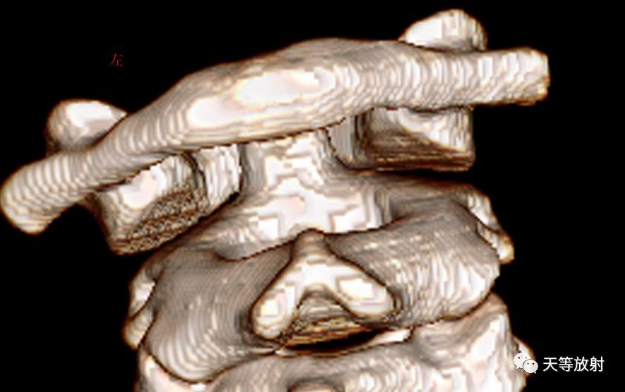 环枢椎关节半脱位-6