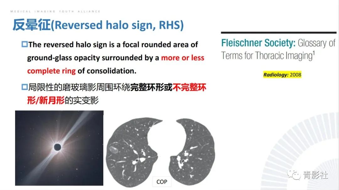 【PPT】肺部反晕征影像诊断思维-3