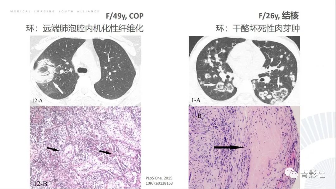 【PPT】肺部反晕征影像诊断思维-9