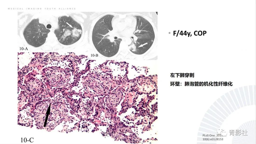 【PPT】肺部反晕征影像诊断思维-14