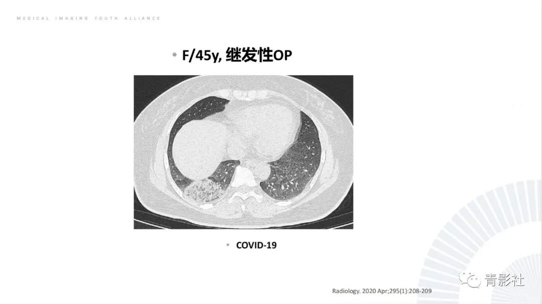 【PPT】肺部反晕征影像诊断思维-15