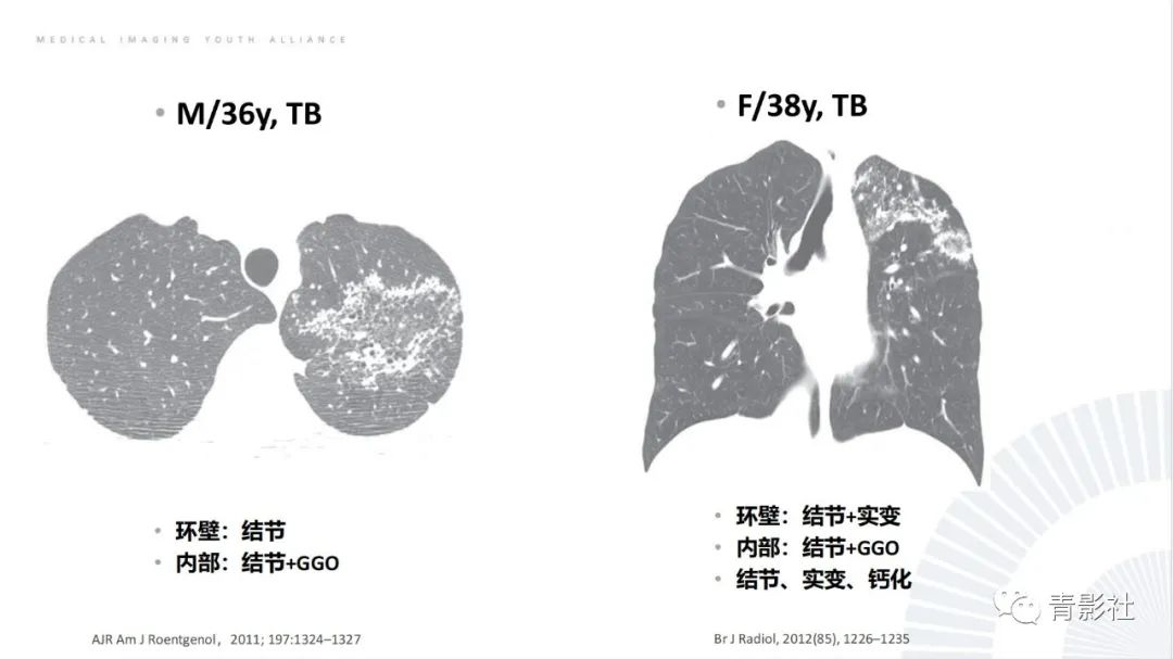 【PPT】肺部反晕征影像诊断思维-19