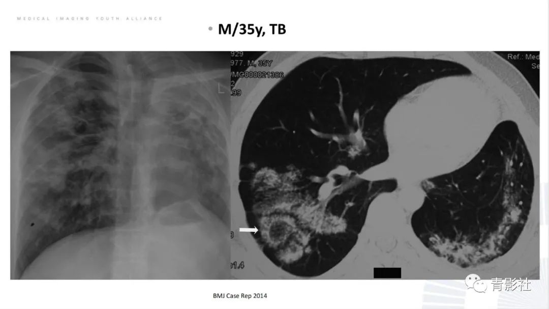 【PPT】肺部反晕征影像诊断思维-20