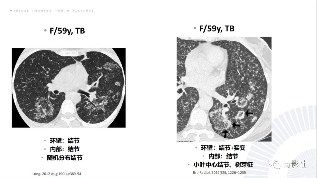 【PPT】肺部反晕征影像诊断思维-18