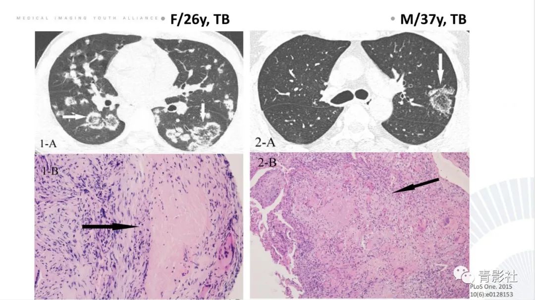【PPT】肺部反晕征影像诊断思维-21