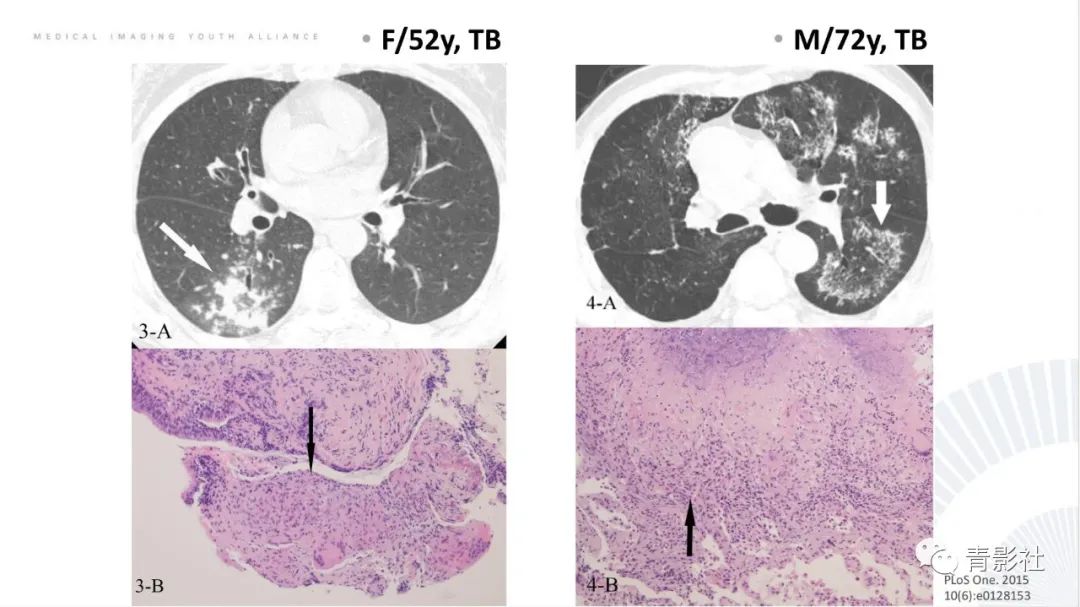 【PPT】肺部反晕征影像诊断思维-22