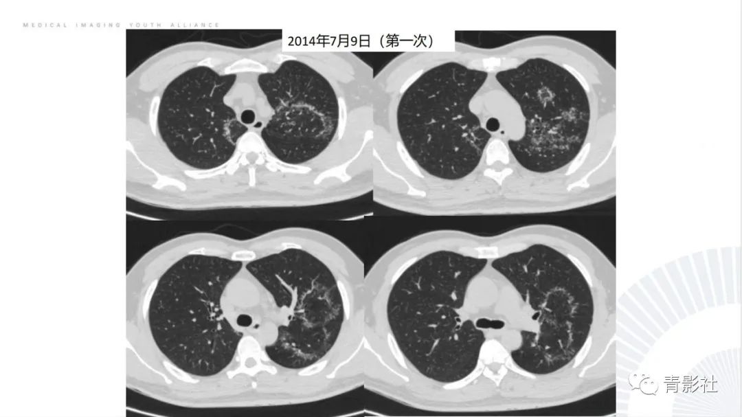 【PPT】肺部反晕征影像诊断思维-24