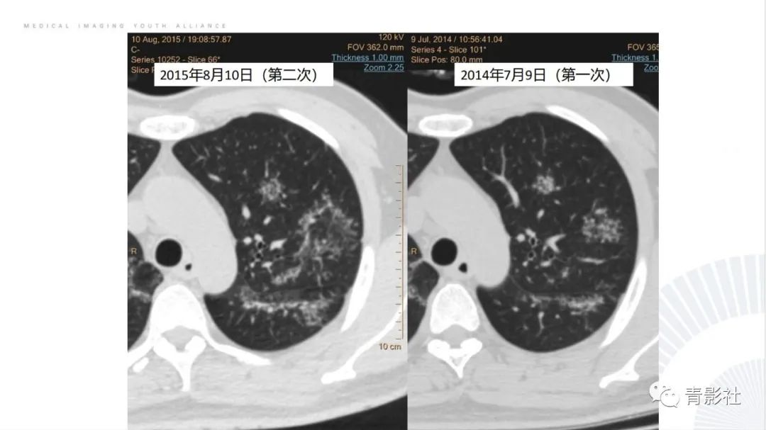 【PPT】肺部反晕征影像诊断思维-25