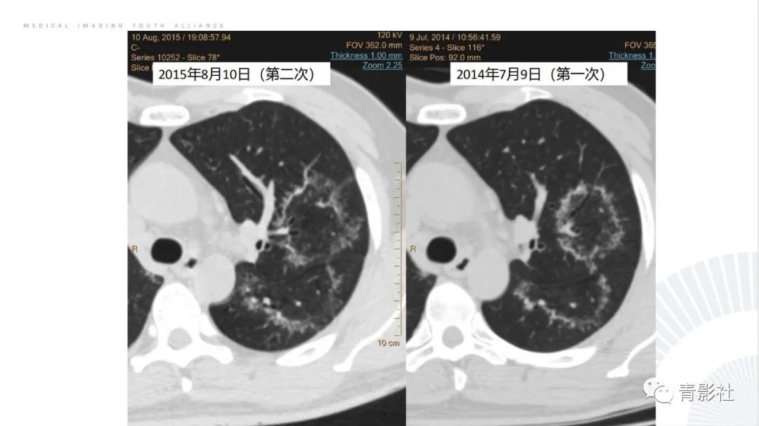 【PPT】肺部反晕征影像诊断思维-26