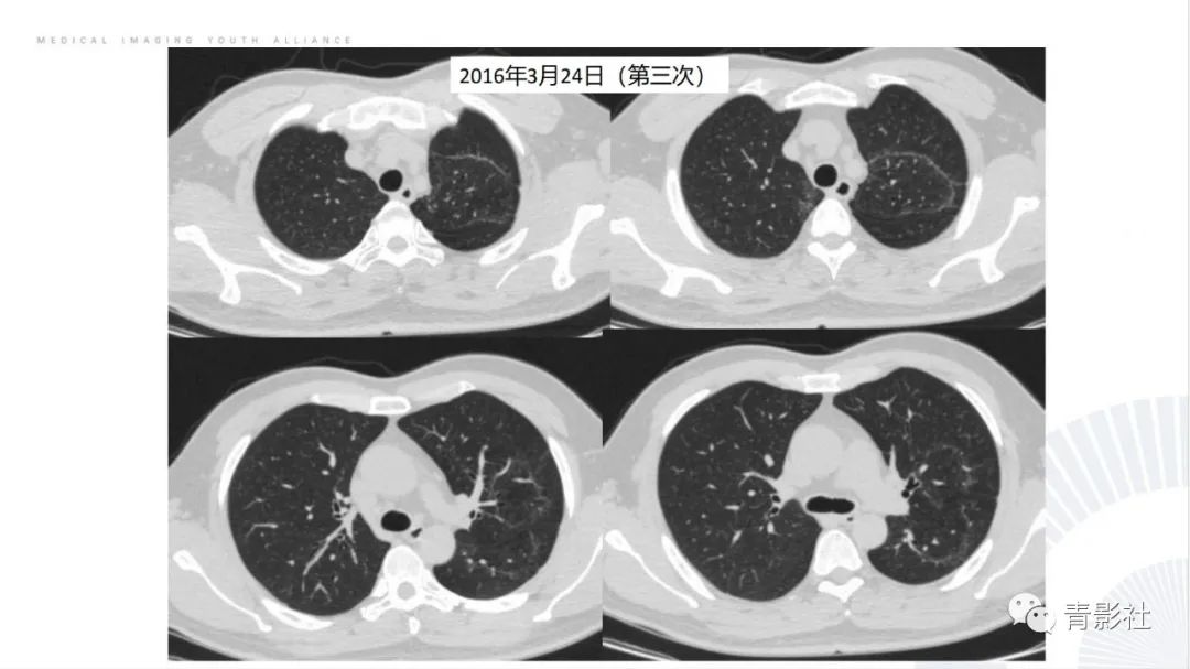 【PPT】肺部反晕征影像诊断思维-27