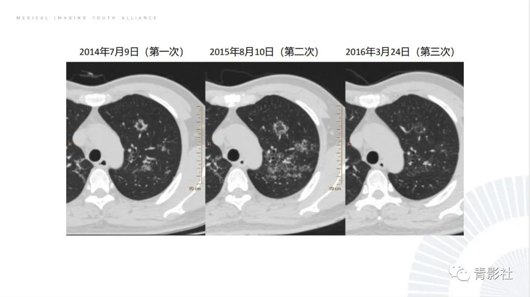 【PPT】肺部反晕征影像诊断思维-28