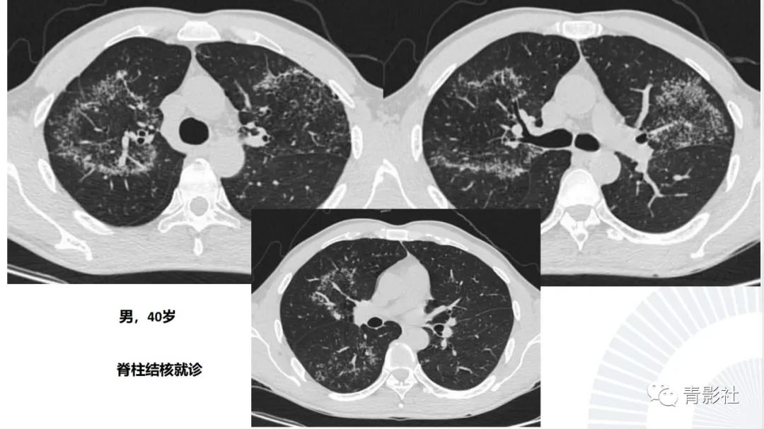 【PPT】肺部反晕征影像诊断思维-29
