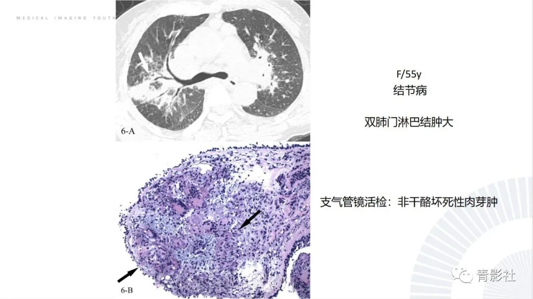 【PPT】肺部反晕征影像诊断思维-32