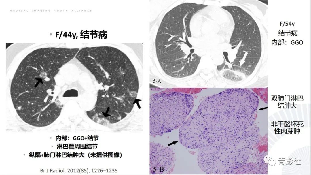 【PPT】肺部反晕征影像诊断思维-31