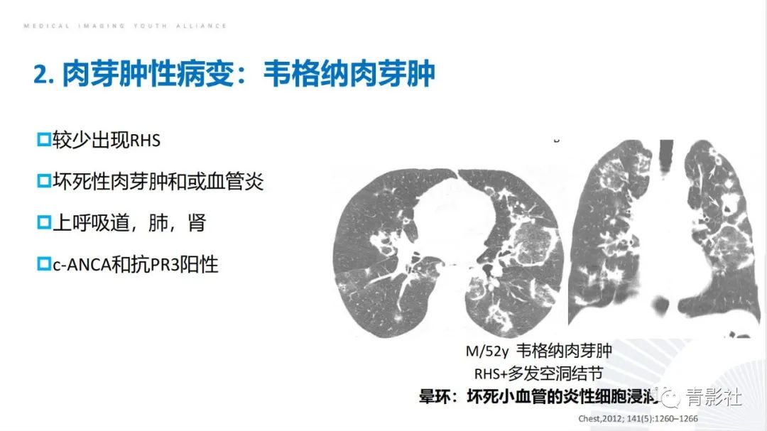 【PPT】肺部反晕征影像诊断思维-33