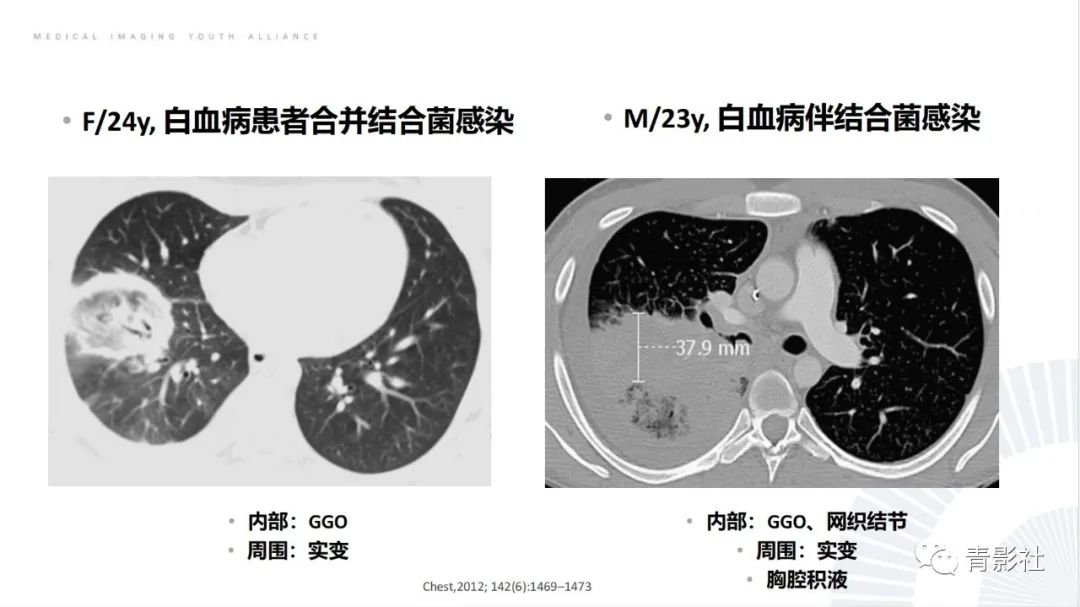 【PPT】肺部反晕征影像诊断思维-36
